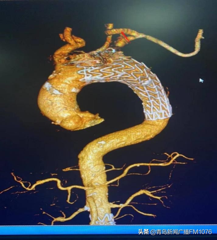 海慈血管外科中心开展高难度杂交手术为患者解除胸主动脉弓动脉瘤危机