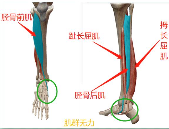 小腿肌肉外翻和膝盖内扣一样吗,小腿肌肉外翻骨头是弯的