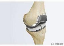 骨刺和骨性关节炎哪个更严重,骨刺也是骨性关节炎吗