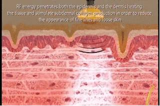 电动导入美容仪提拉紧致脸部眼部,导入美容仪提拉紧致