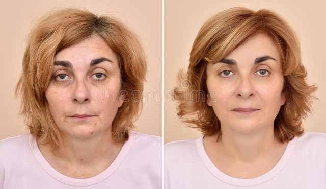 头发稀少者如何增发,中年男人头发稀少增发方法