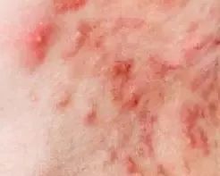 后背痘痘类型及处理方法医用,背部痘痘种类及症状