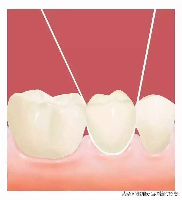 牙缝大是福是祸,牙缝宽什么命运