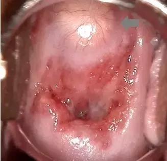 宫颈糜烂二度宫颈肥大宫颈囊肿,宫颈糜烂肥大囊肿会引起宫颈癌吗