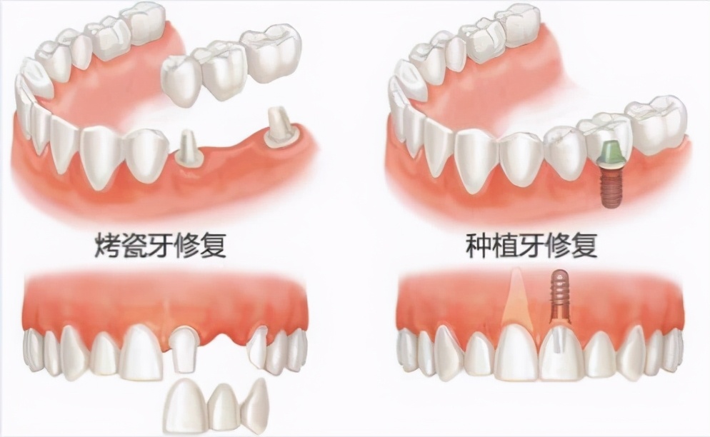 选择一个好的口腔种植牙,口腔种植牙了解一下