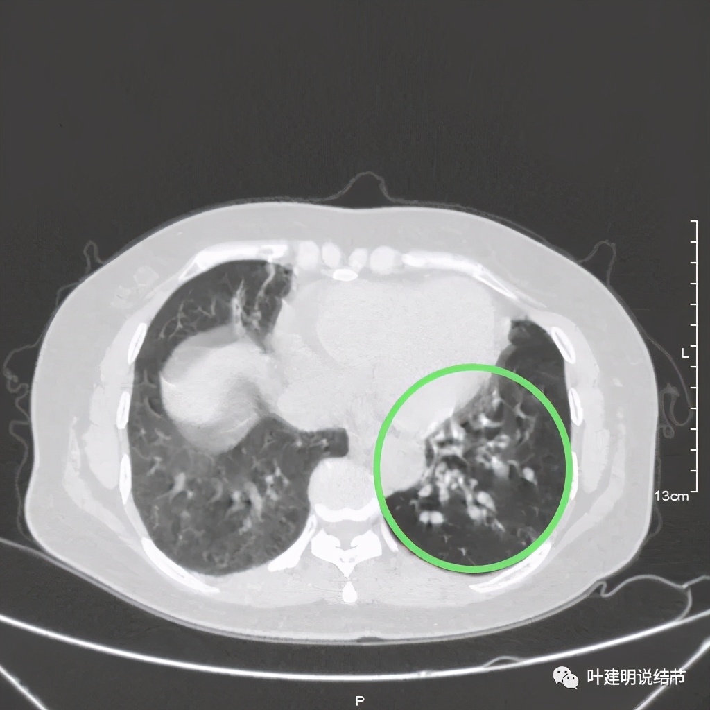 这样的实性结节伴小空洞会是肺癌吗？