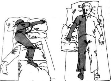 分期针刺治疗脑卒中后肢体功能障碍