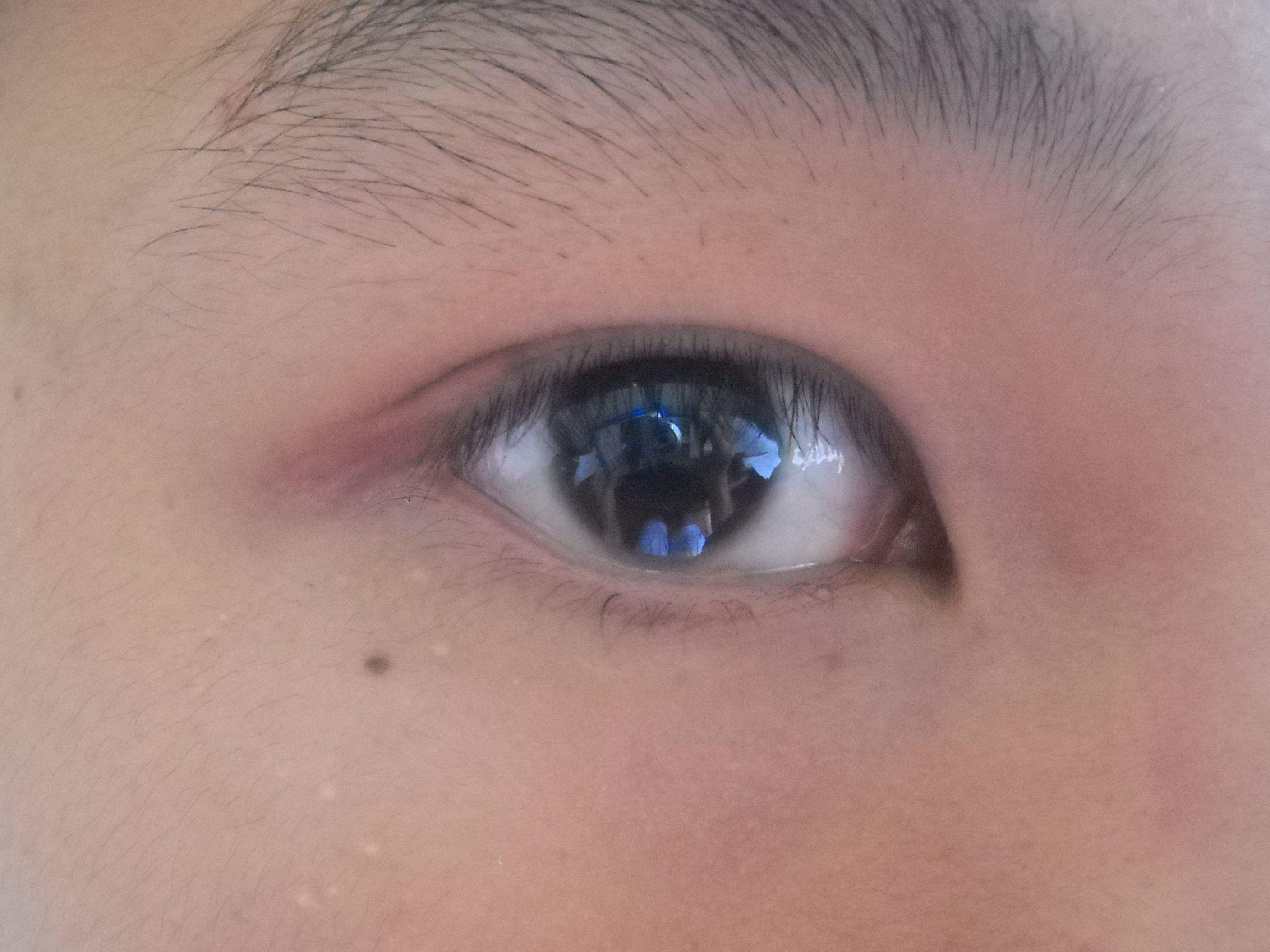 眼睛有泪痣人中有痣是不是不好,泪痣代表什么面部哪些痣必须点掉