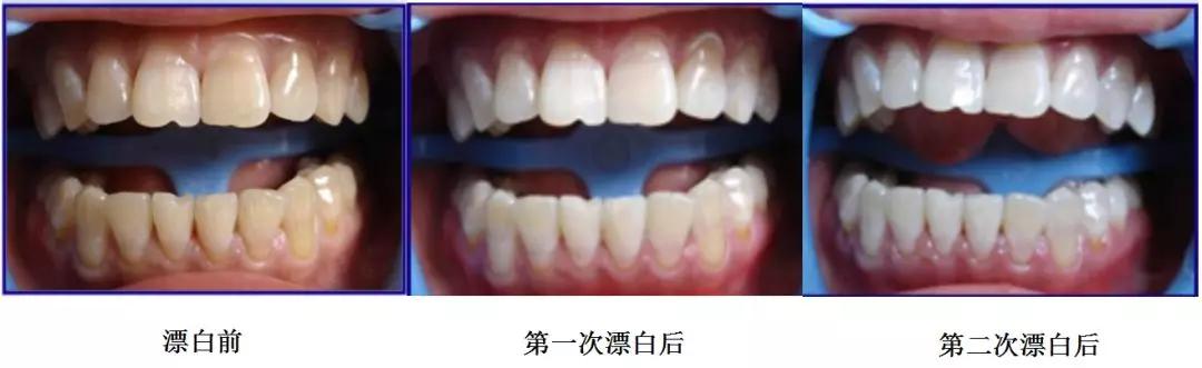 医院冷光美白牙齿大概多少钱,天津牙齿冷光美白哪家口碑好