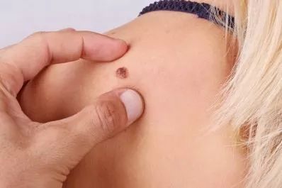 抗癌疫苗的研发,抗癌疫苗