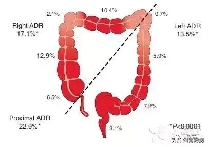 大肠息肉—藏在肚子里的定时*弹炸**，只要发现，必须格杀勿论！