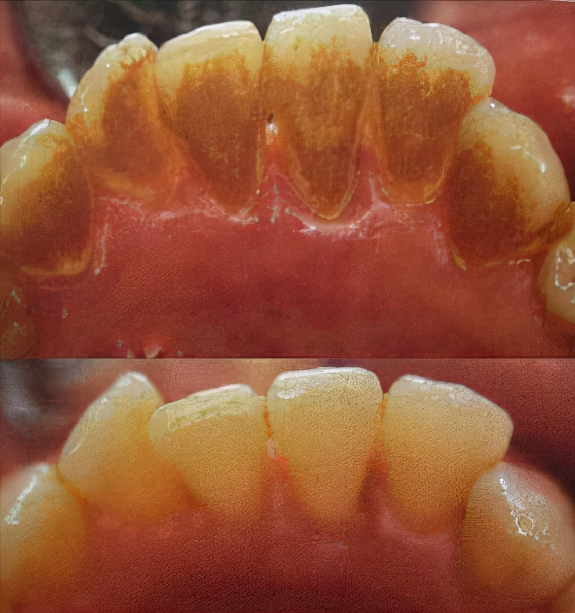14岁牙齿黄可以洗牙变白吗,牙齿出血发黄去洗牙