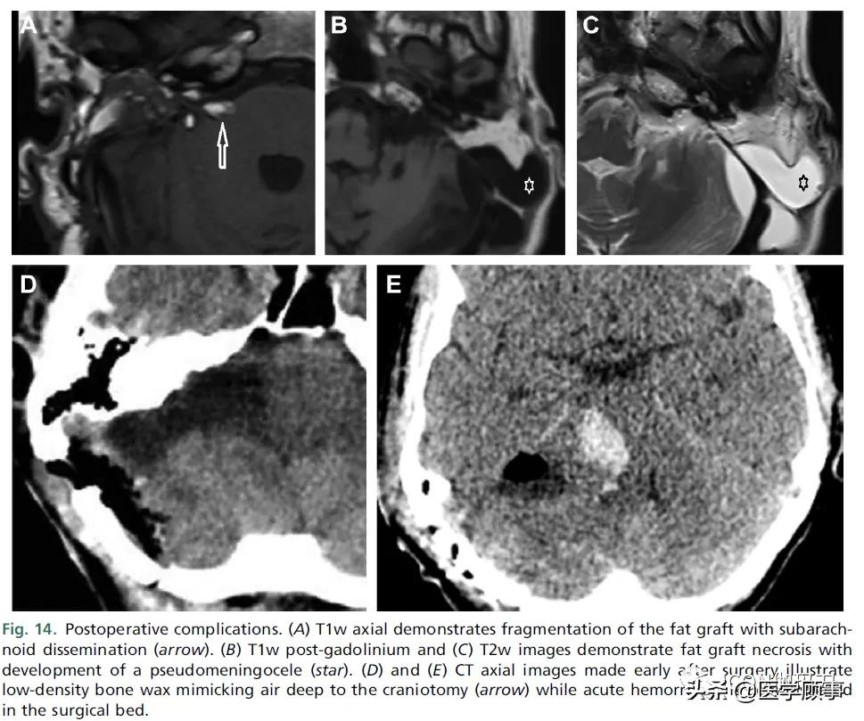 「综述」前庭神经鞘瘤的成像：诊断、监测、和治疗计划