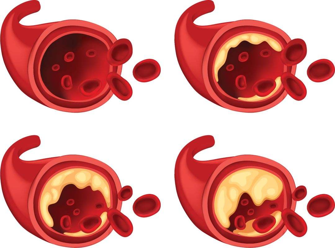 丙酸血症是怎么引起的啊,丙酸血症是什么意思