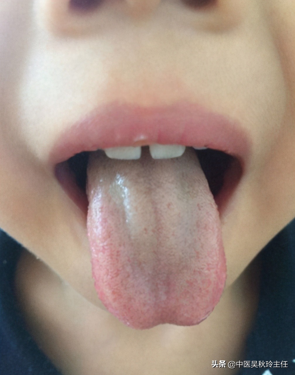 小孩厌食不吃饭该怎么办,孩子厌食不爱吃饭补锌