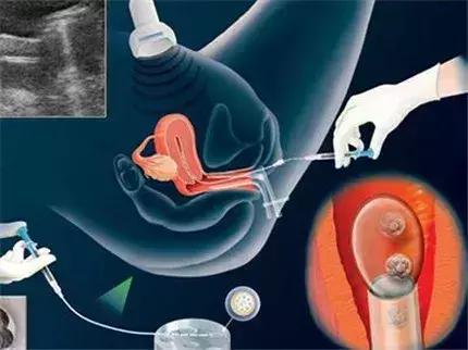 密蜜诗蕊丨“捐卵后”,是交不完的智商税