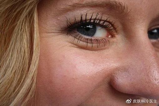 异维a酸治痘效果如何,治疗痘痘的异维a酸软胶囊