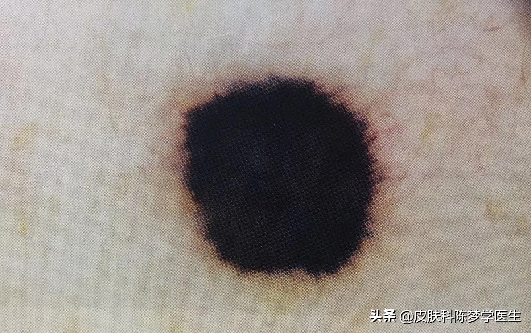 激光点痣真的会导致痣发生癌变吗,脸上有痣能激光点痣吗