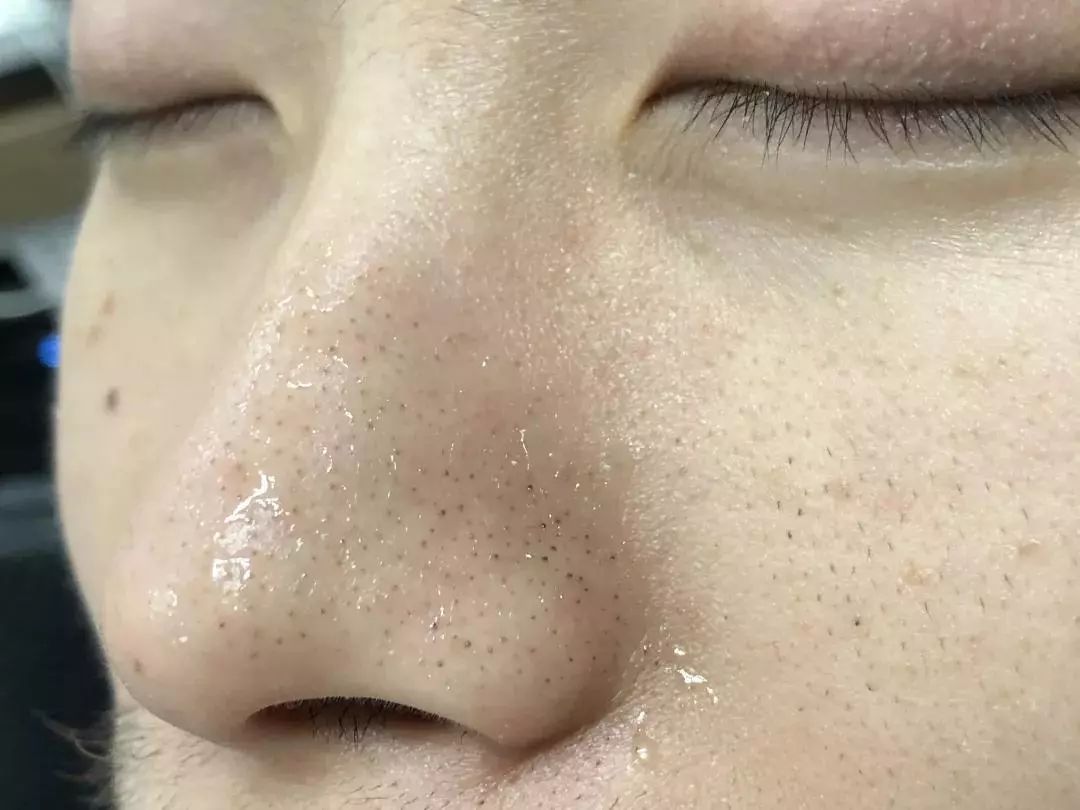 荷荷巴油去黑头真的有效吗,荷荷巴油去黑头正确使用方法