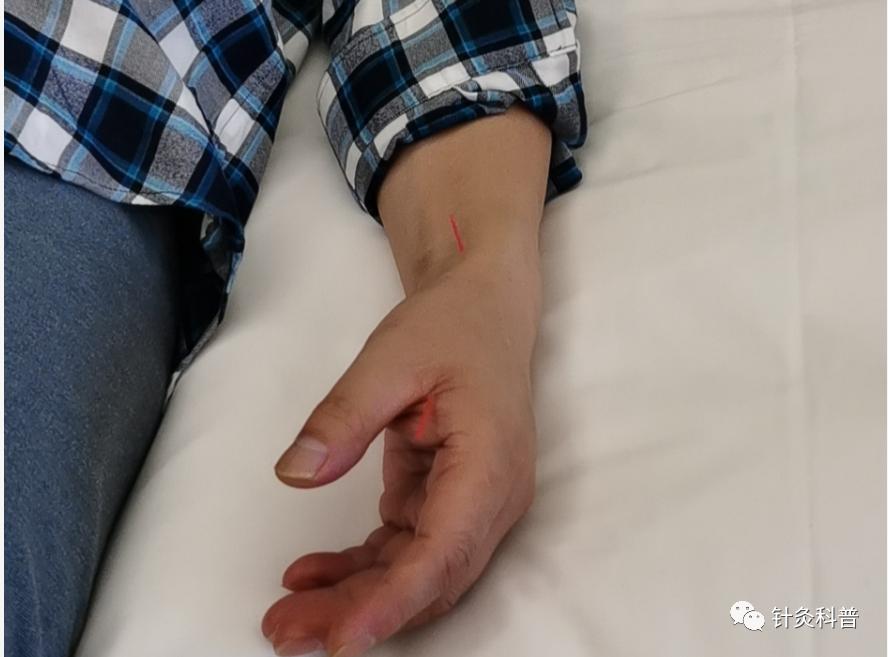 针灸治疗颈椎病视频全集,颈椎病针灸下针手法视频