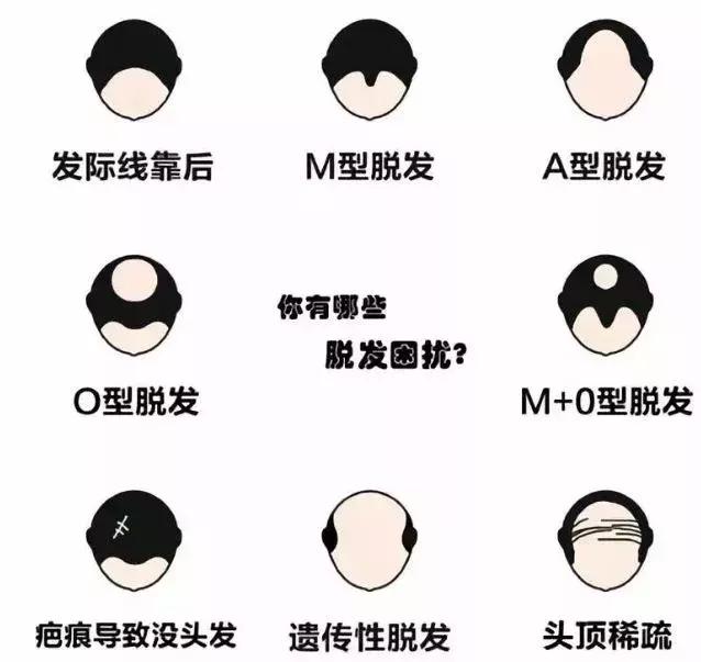 治疗脱发大部分都是骗人的吗,治脱发药有效吗