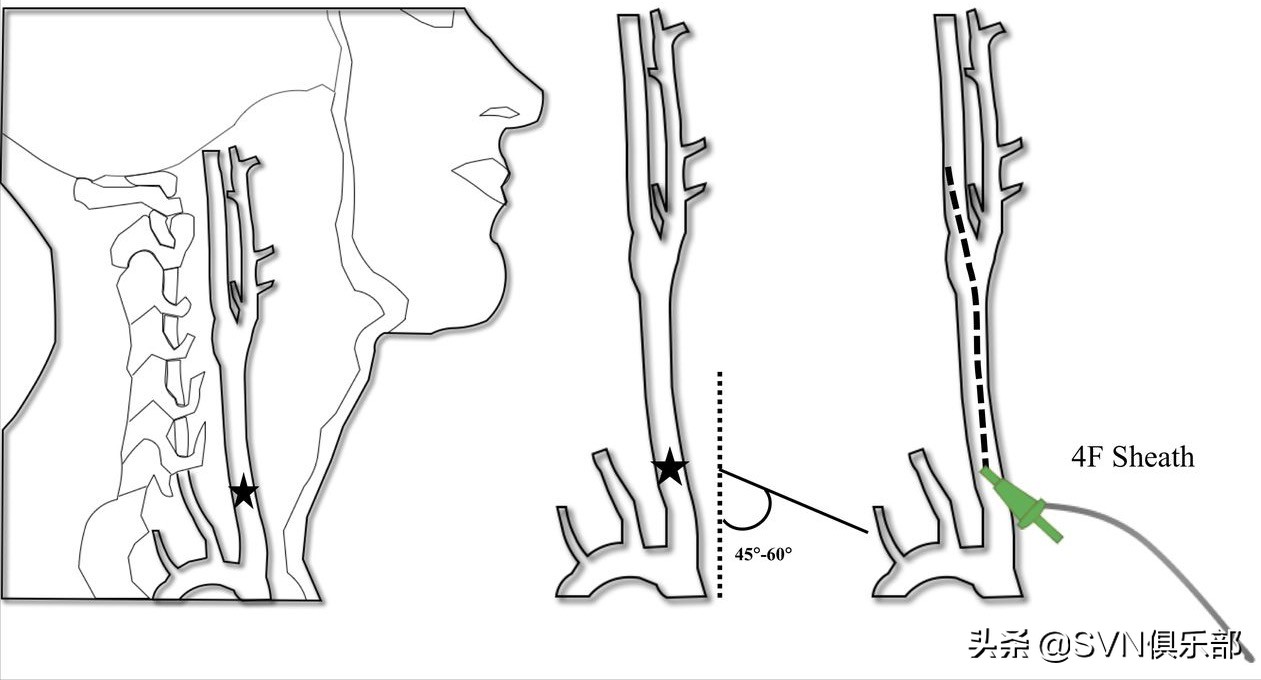 出版简讯｜直接颈动脉穿刺治疗急性缺血性卒中