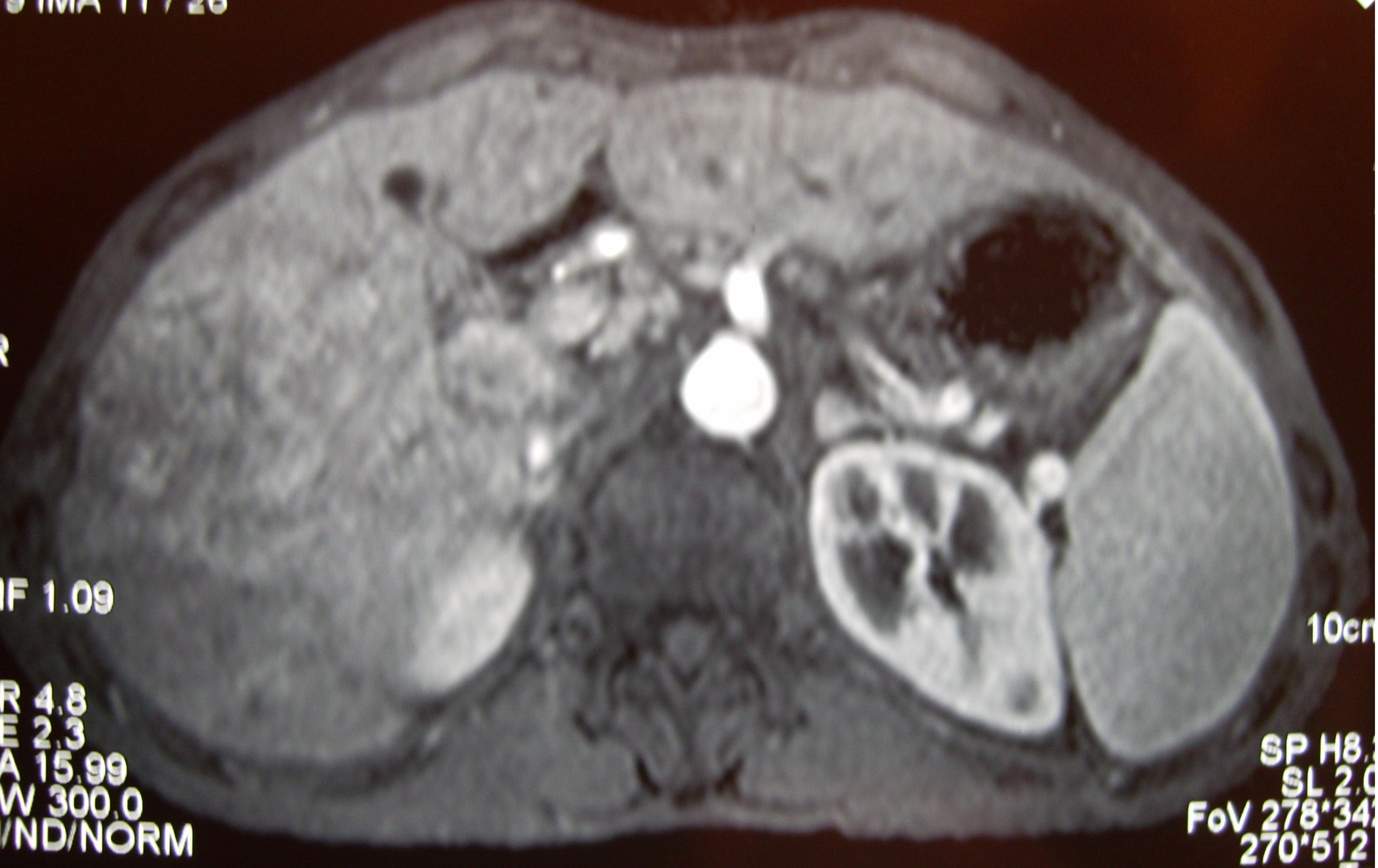 肝癌晚期保守治疗的成功案例,肝癌晚期治疗存活2年以上的案例