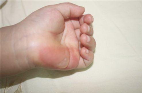 儿童手指夹伤怎么处理,三岁女童手指被压断后续