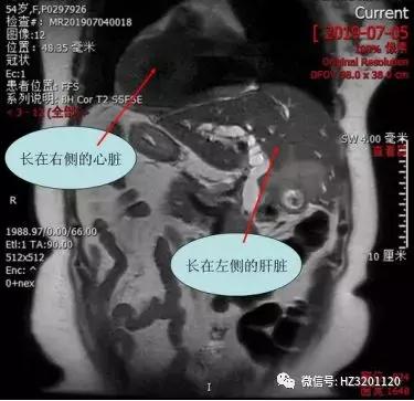 ercp胆道支架植入,ercp胆道支架植入术青大附院