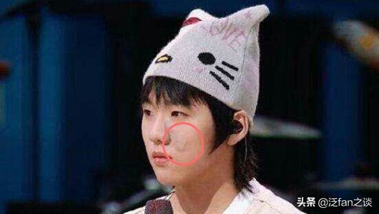 陈卓璇脖子的胎记用什么遮住了,陈卓璇谈胎记