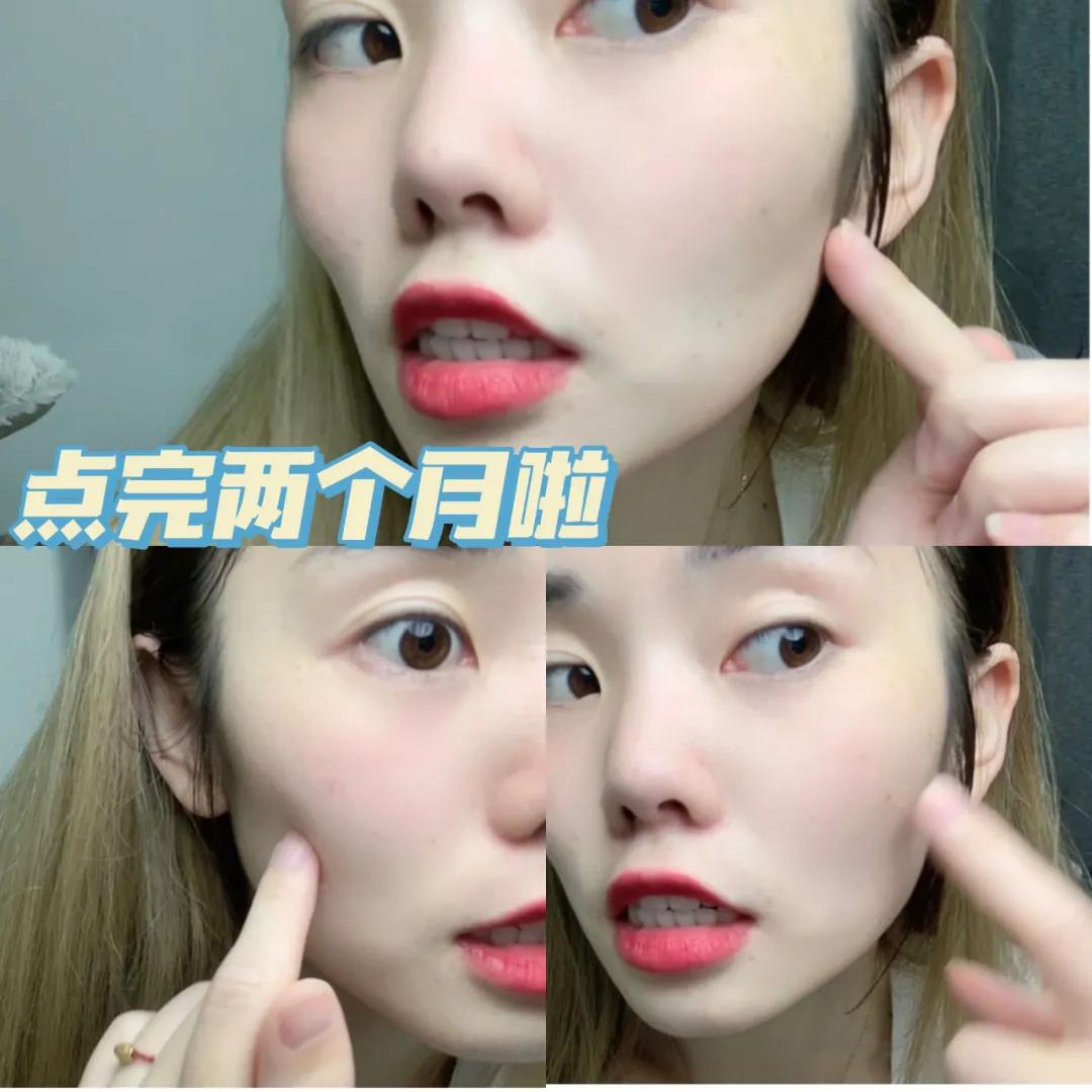 药水点痣一星期了还忌口吗,药水点痣后续护理