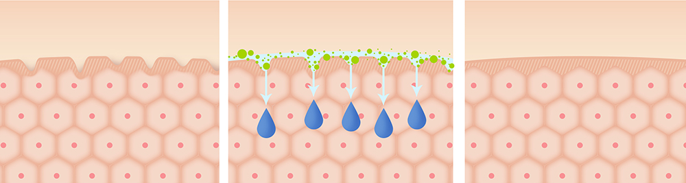 晒后起皮如何有效补水,晒伤干皮后如何修复