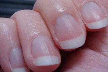 指甲月牙少有白点,指甲月牙消失有竖纹是怎么回事
