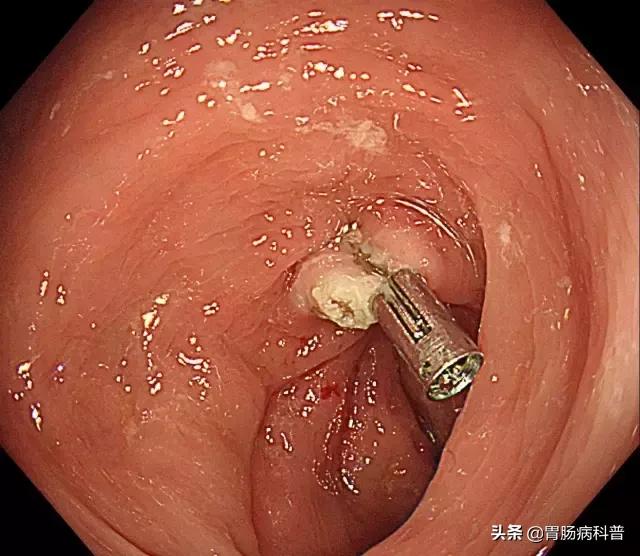 增生性肠息肉切除后几年复查合适,肠息肉0.6厘米切除后多久再复查