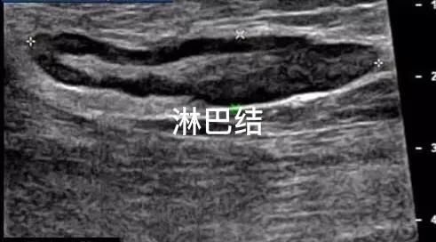 颈部淋巴结肿大恶性彩超报告单,颈部淋巴结肿大恶性会危及生命吗