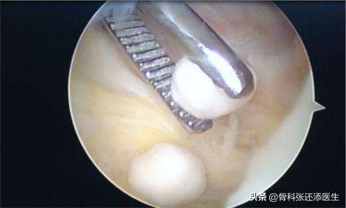 花椒和白醋对关节炎积液有效果吗,盐加花椒热敷膝关节积液管用吗