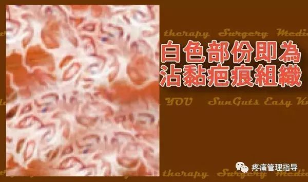 网球肘能自我恢复吗,网球肘病因的解剖学研究