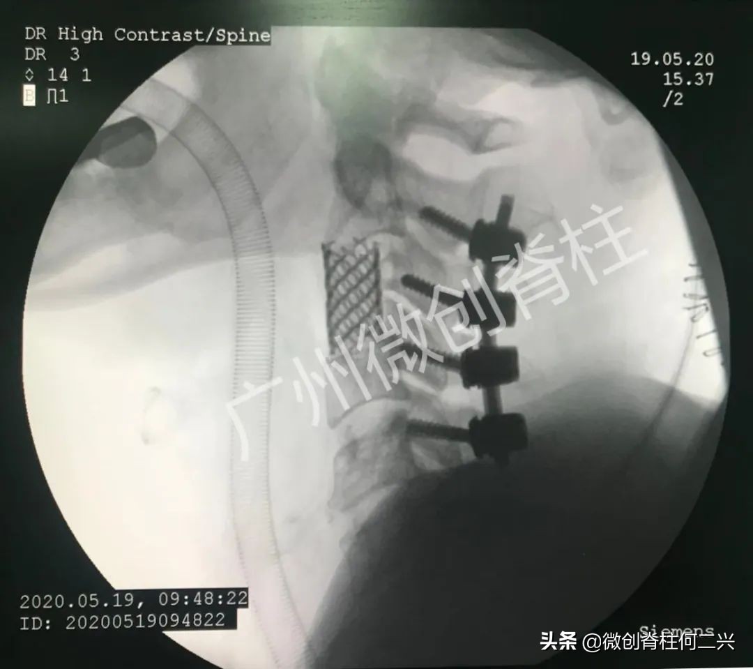 超微创靶点颈椎,微创治颈椎突出效果怎样