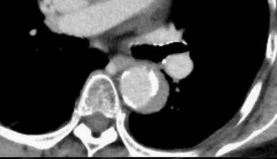 如何监测动脉夹层早期,动脉增强ct能查出主动脉夹层么