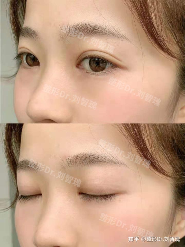 埋线双眼皮的术后修复注意事项,埋线双眼皮术后注意事项有哪些