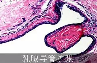 乳腺导管扩张需要做钼靶吗,乳腺导管扩张2mm严重吗还经常痛