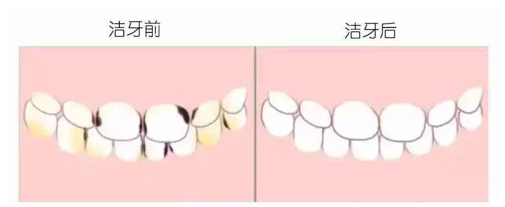 牙齿有黑线就证明里面坏了吗,牙齿有黑渍一定是龋齿吗