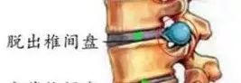 腰椎间盘突出坐骨神经痛如何缓解,腰椎间盘突出脚痛神经痛怎么缓解