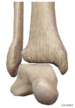 脚踝骨折手术后怎么预防血栓,脚踝骨折怎么按摩预防肌肉萎缩