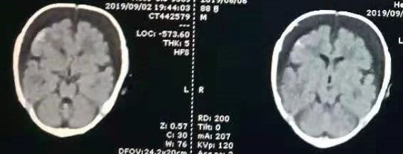 头发卷曲毛躁身体有什么问题,头发卷曲毛躁是什么基因