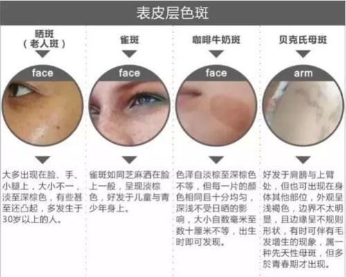 褐斑内调方法,褐斑的原因和治疗方法