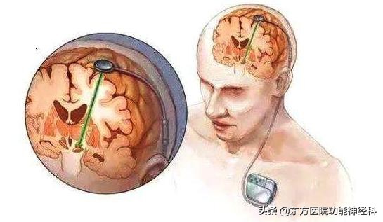 东方医院带你探究DBS能治疗哪些病？
