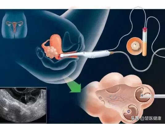专家揭秘不孕不育的真正元凶,治疗不孕不育最好的名医
