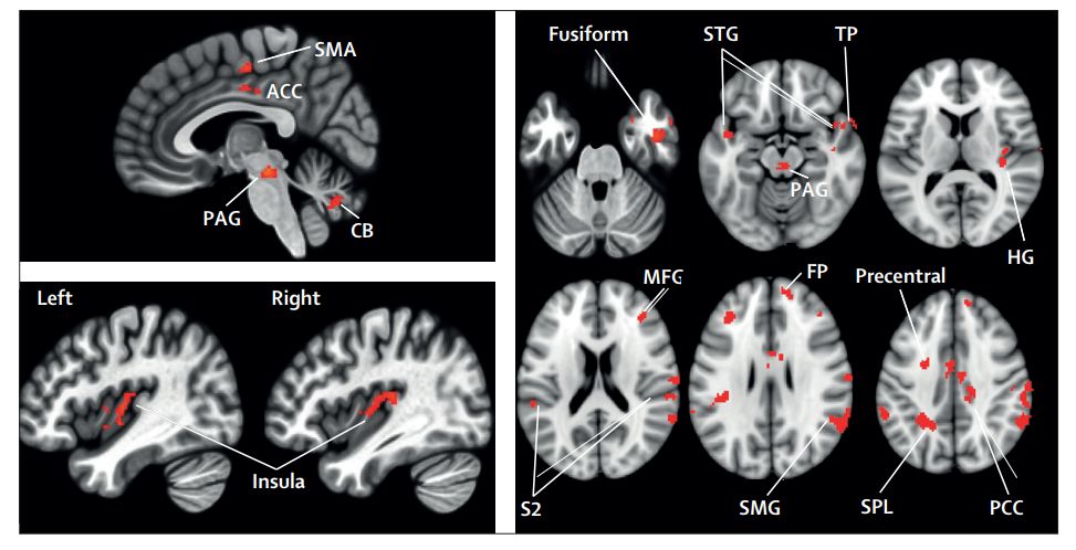 改善认知功能障碍抗抑郁药,新型治疗抑郁症药对比