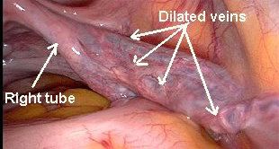 慢性腹痛竟是静脉曲张惹的祸